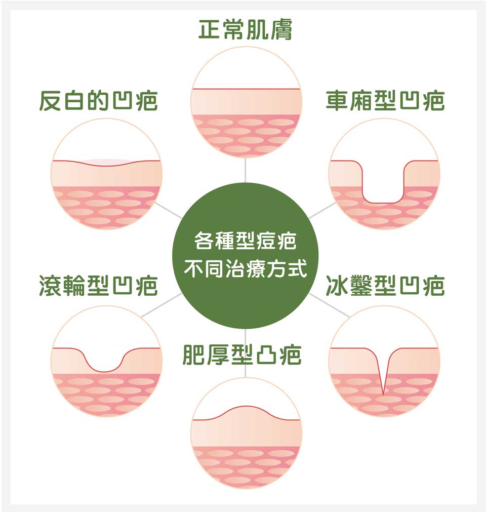 各類型痘疤型態
